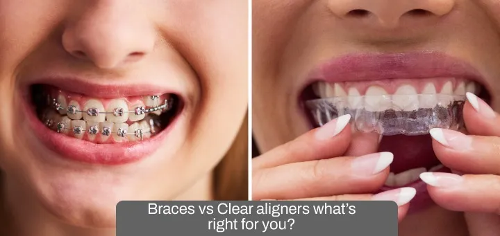 Braces vs. Clear Aligners: What’s Right for You?