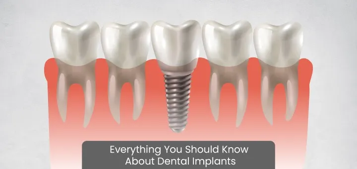 Everything You Should Know About Dental Implants & Treatment