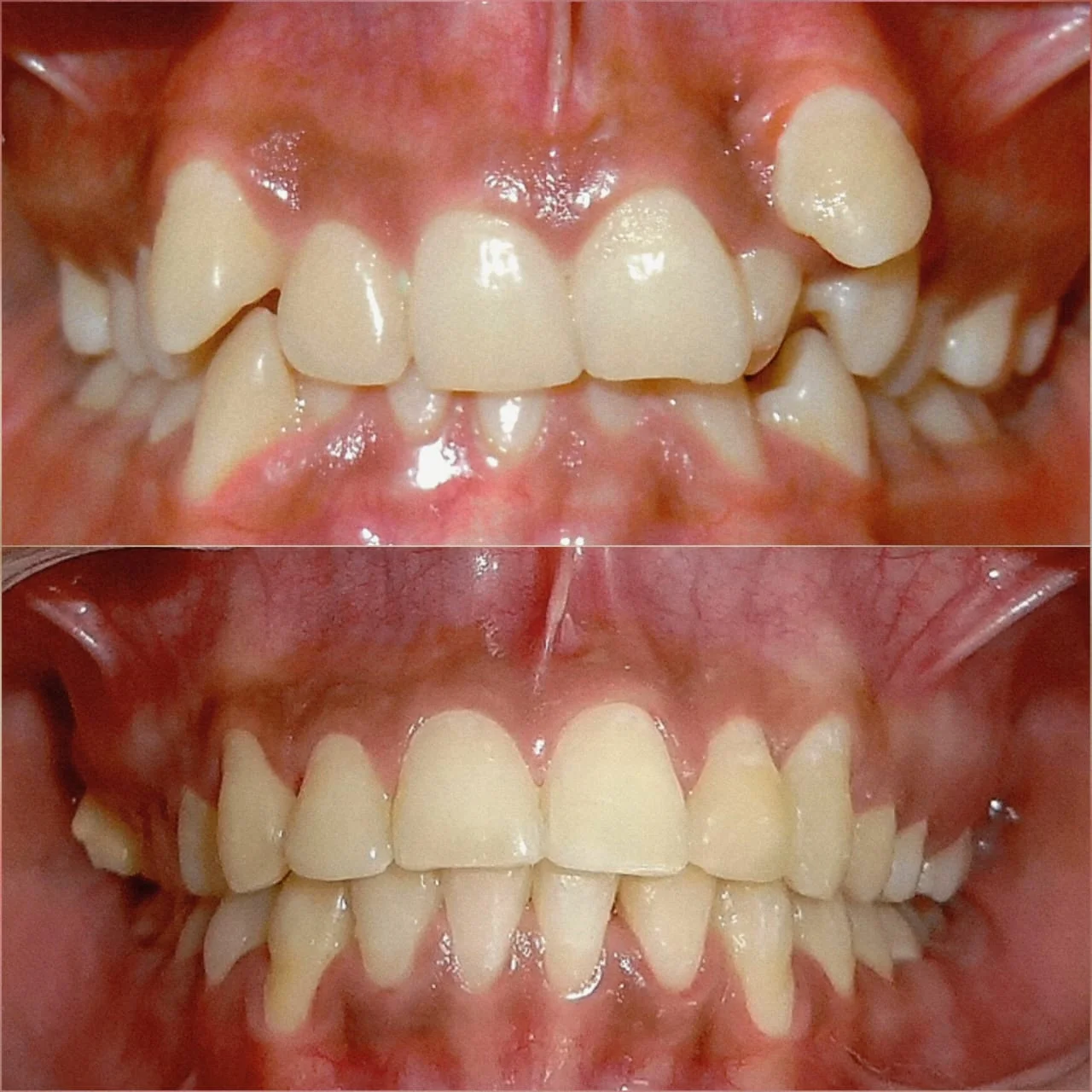 Dentures at New Smile Multi Speciality Dental Clinic