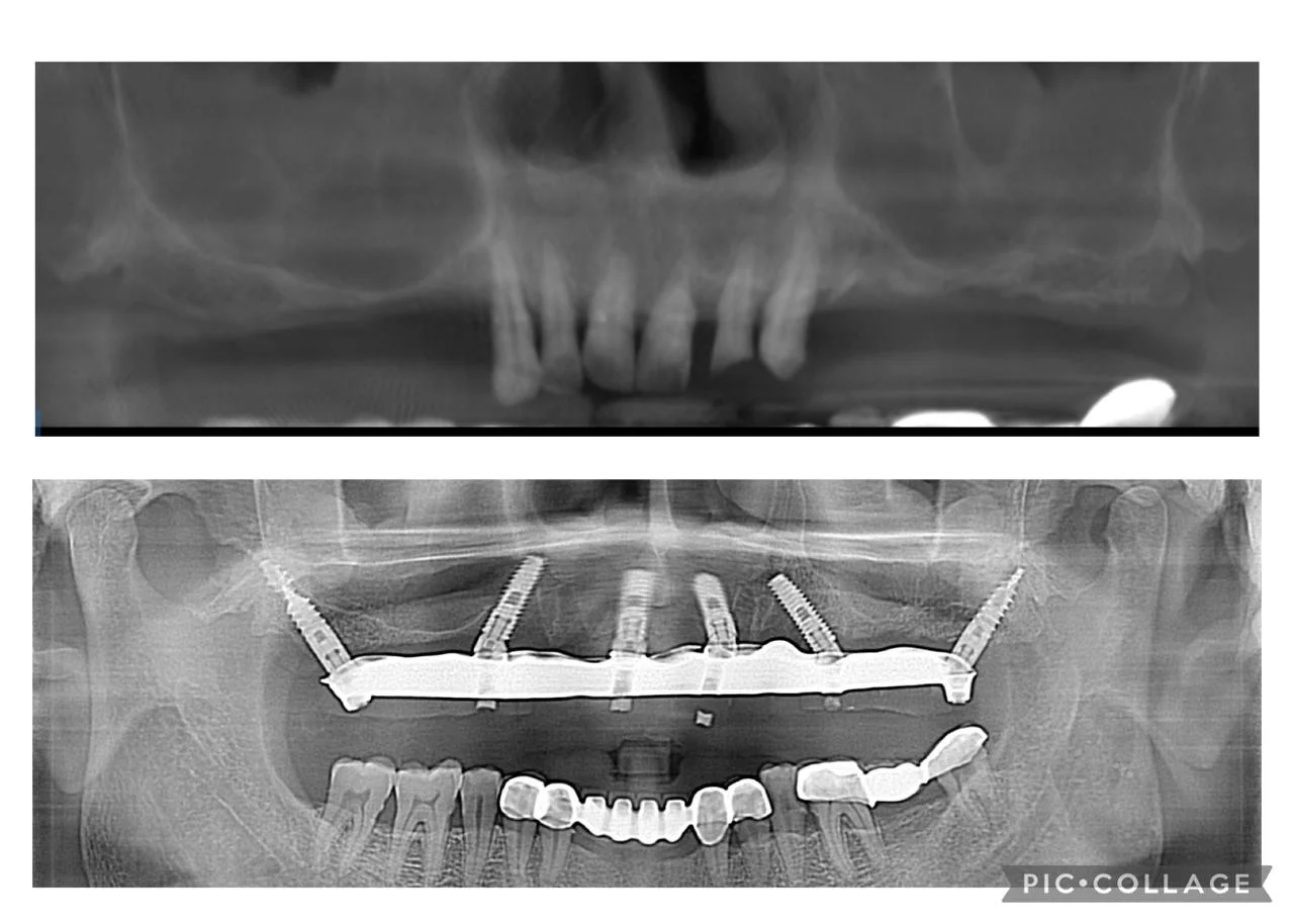 Full Mouth Rehabilitation and Crown Bridge Restoration Case