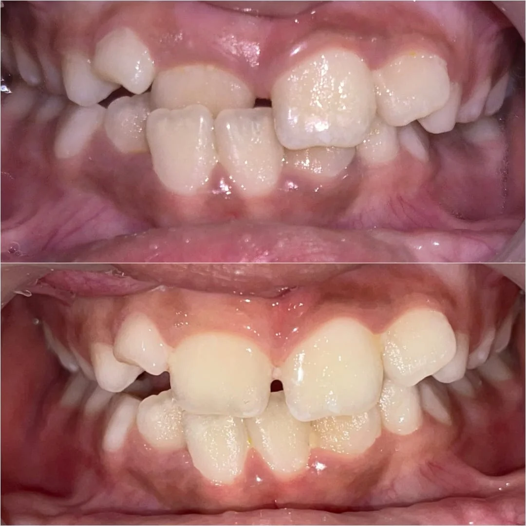 Cosmetic Smile Design Makeover with Custom Porcelain Veneers