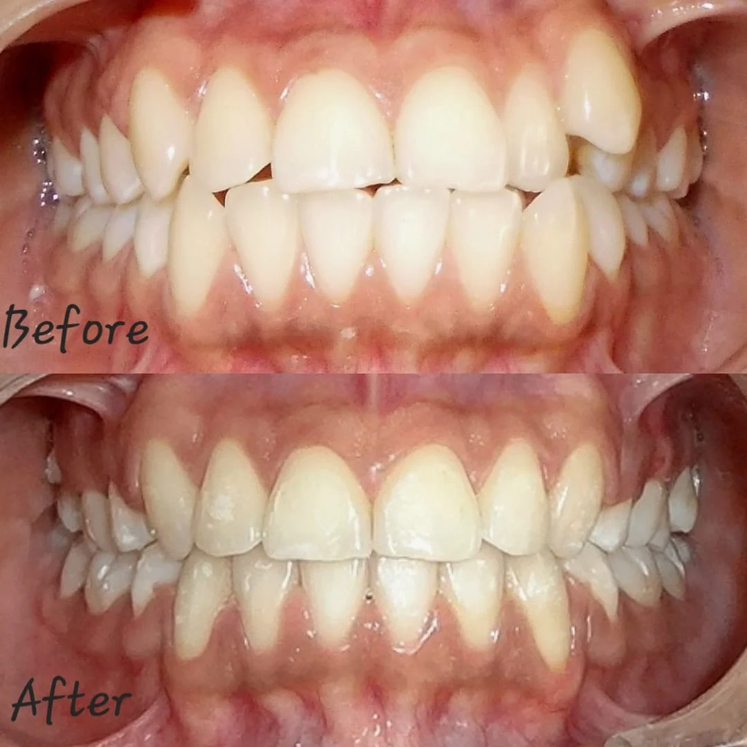 Gentle Pediatric Dental Preventive and Cavity Treatment Session